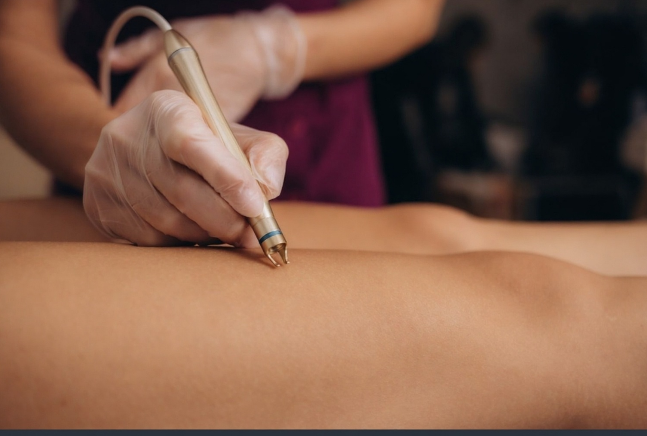 The Ultimate Guide to Spider Vein Removal: Options, Results, and What to Expect