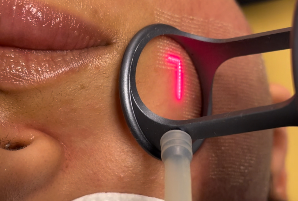 Unveiling the Power of CO2 Fractional Laser vs. RF Microneedle Therapy: A Comprehensive Guide
