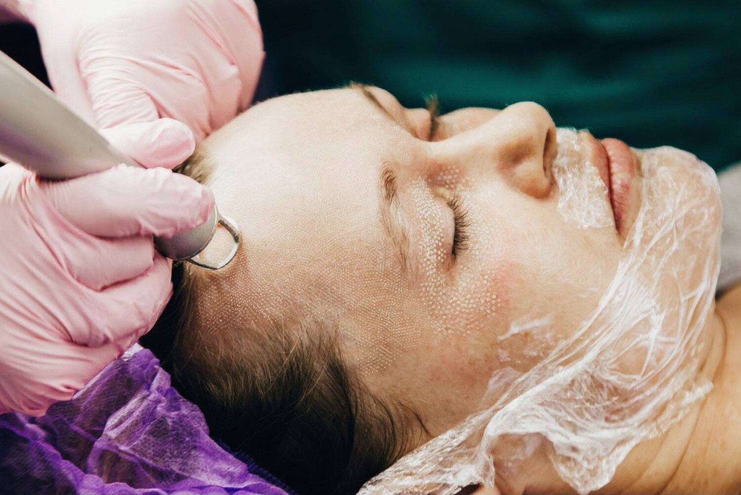 Fractional CO2 Laser: The Complete Guide for Smoother, Younger-Looking Skin